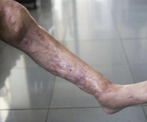 methotrexate Vasculitis | Shaanxi BLOOM Tech Co., Ltd methotrexate Vasculitis | Shaanxi BLOOM Tech Co., Ltd